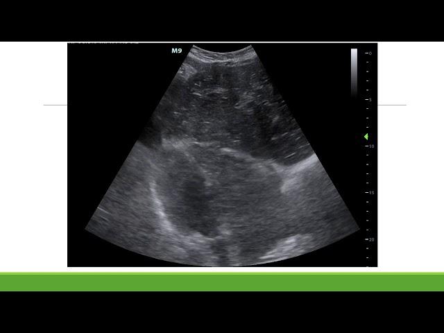 UH CMC ED - ultrasound cases: #1 cardiac arrest