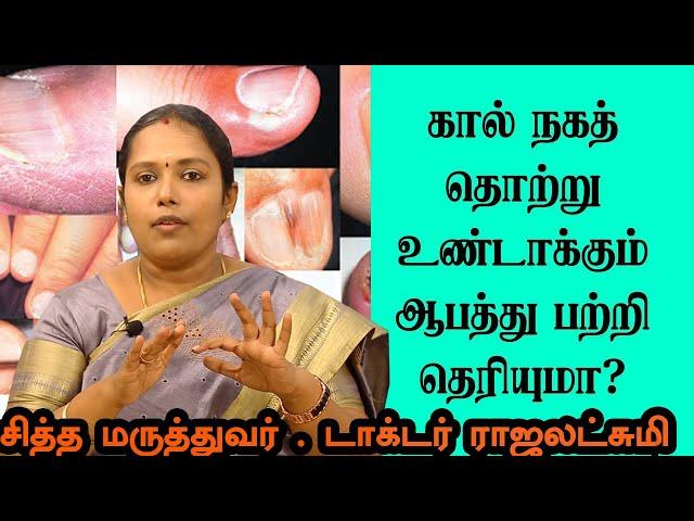 நகச்சொத்தை பிரச்சனைக்கு இயற்கை முறையில் முழு தீர்வு | Nagasothai Natural Treatment | Dr.Rajalakshmi