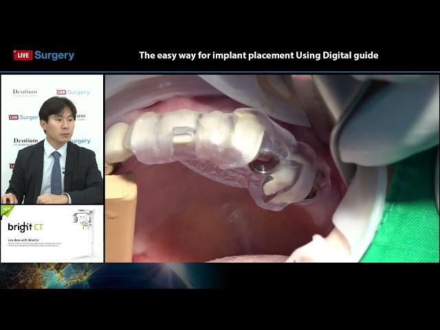 Dentium 221021 Live Surgery - The easy way to implant placement using Digital guide