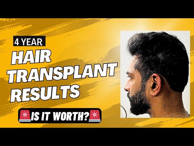 My 4 Years Hair Transplant Results  #ameerht #hairfall