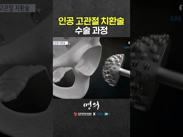 Hip Arthroplasty Surgery Method