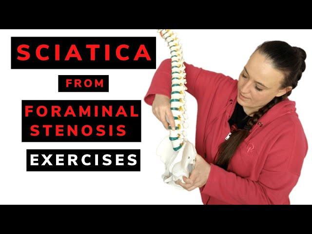 Sciatica from foraminal stenosis - exercises.