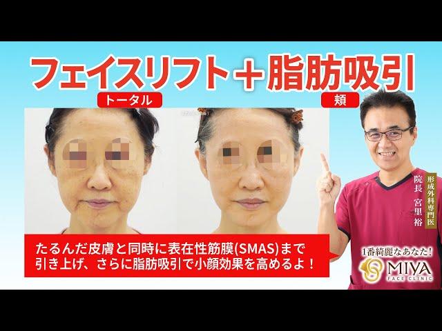 【たるみ取りの効果最大！】フェイスリフト(トータル)＋脂肪吸引(頬)の施術と症例 ／MIYAフェイスクリニック