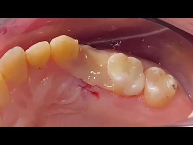 Wound Stability