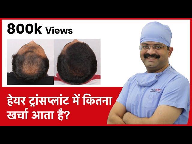 What Is The Cost Of Hair Transplant In India (हेयर ट्रांसप्लांट में कितना खर्चा आता है) | (In HINDI)