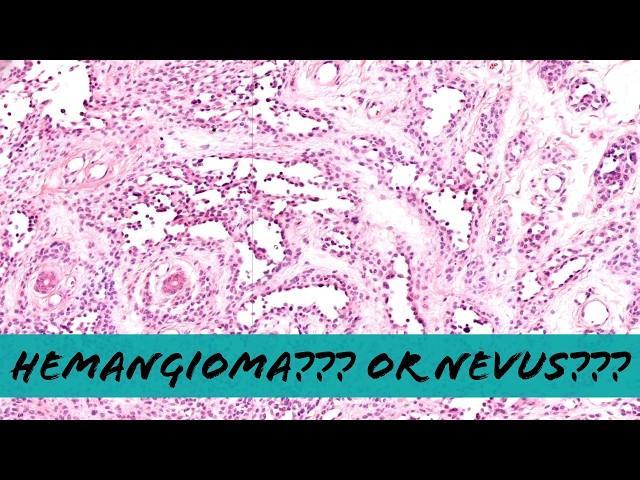 Nevus mimicking hemangioma (pseudovascular/pseudoangiomatous nevus) pathology dermatopathology