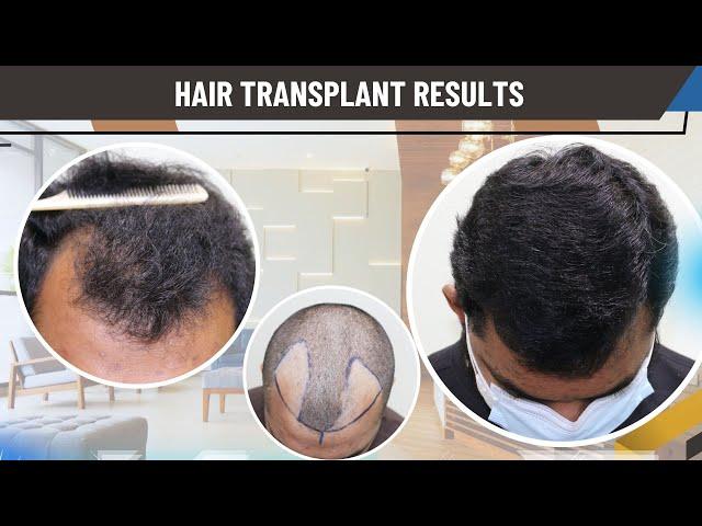 Hair Transplant In Shimoga | Best Clinic Center surgeon & Results Of Hair Transplant In Shimoga