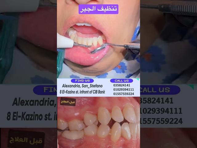 Dental Scaling | تنظيف جير الاسنان بعد التقويم #في #امل #مع #دكتور_اسلام_نبيل #لايك #اكسبلور