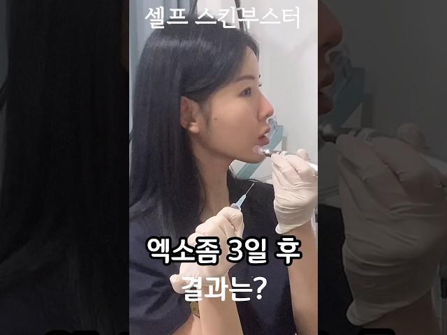 셀프시술 엑소좀 #스킨부스터 3일 후
