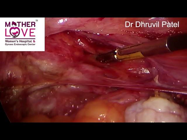 Total Laparoscopic Hysterectomy