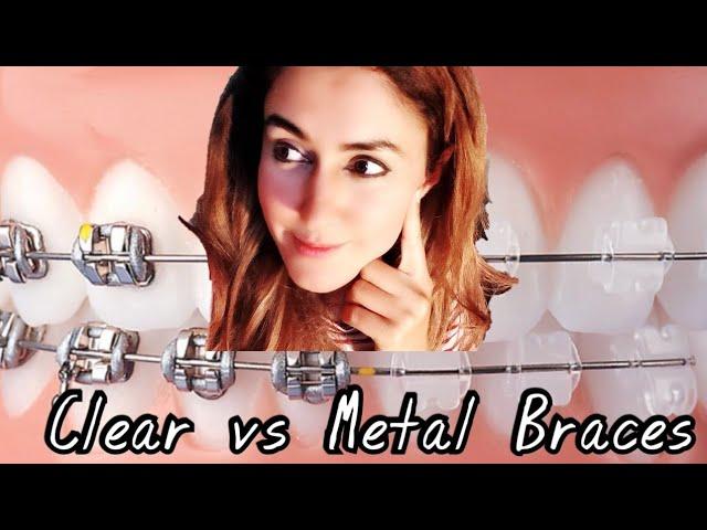 Clear Braces vs Metal Braces