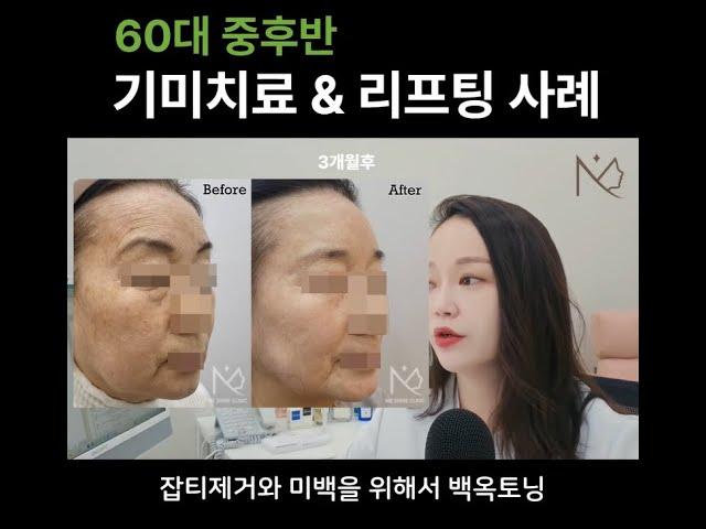 미사피부과 추천 I 기미잡티제거 레이저토닝 시술과 리프팅으로 젊어지신 60대 환자분 사례