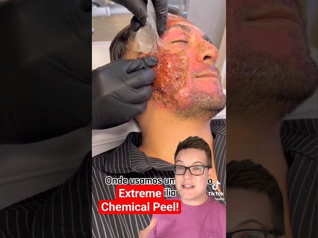 SHOCKING CHEMICAL PEEL - Phenol Peel Results #shorts