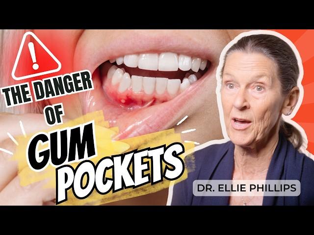 Heal Gum Pockets & Eliminate Deep Cleanings