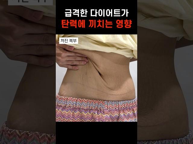 급하게 다이어트 하면 탄력이 이렇게 없어진다고? 처진 팔뚝살,복부,허벅지 안쪽,엉밑살 #슈링크 #실리프팅 #threadlift #shurink #모즈클리닉 #modsclinic