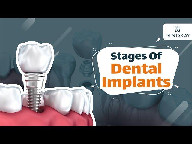 Dentakay | Stages Of Dental Implants