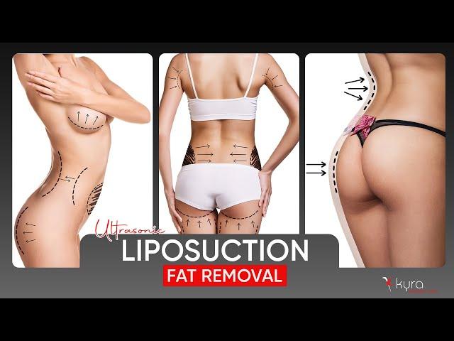 Liposuction Procedure Explained Step-by-Step Dr Vikas Gawri Ludhiana Punjab