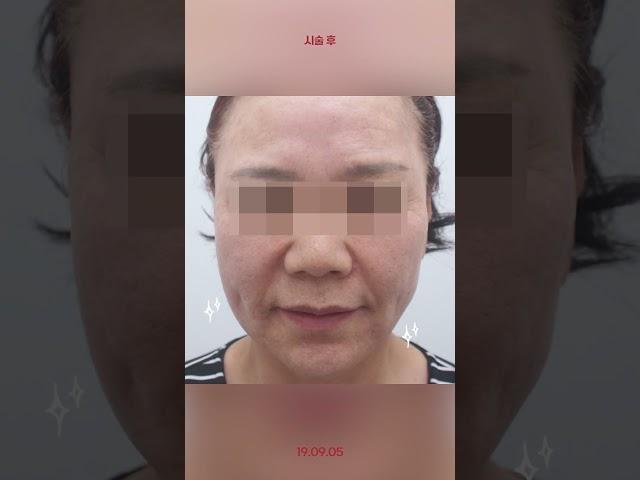 나이들어보이는 입가주름 굿바이~ #입가주름필러 #실리프팅 #앞볼필러