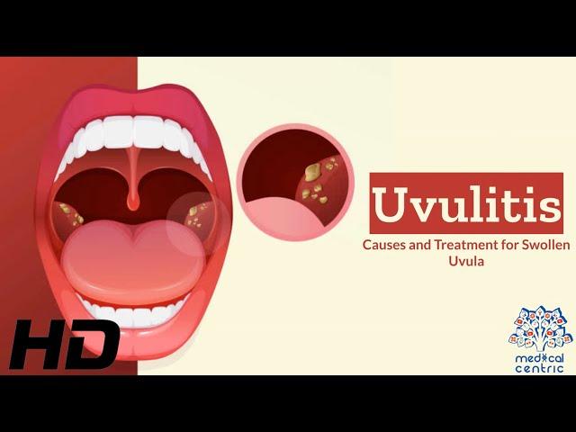 Uvulitis Explained: What's Causing Your Swollen Uvula?