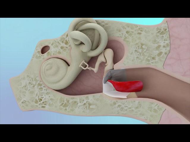 Eardrum Hole Repair Animation