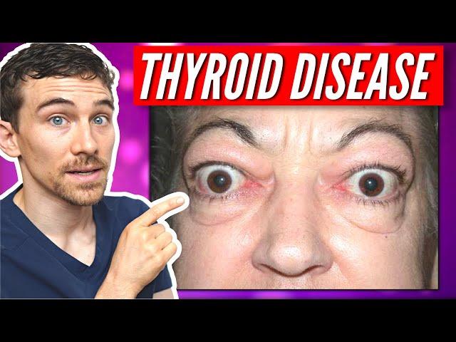 7 Signs of Thyroid Eye Disease and Graves Disease