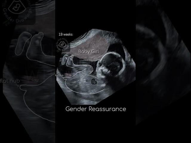 Ultrasound report Baby Boy or Girl? 12 weeks Gender Reveal  #shorts