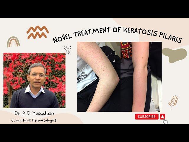 A novel treatment for Keratosis pilaris