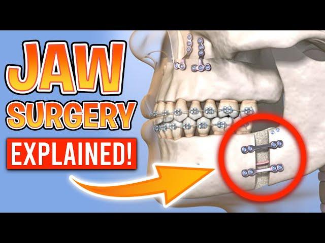 What is Orthognathic Surgery? [Jaw Surgery with Braces Explained]