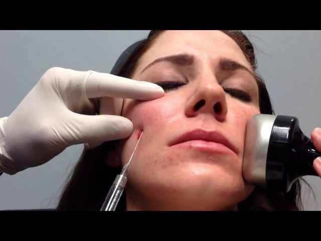 Voluma (Quick Demonstration) for Cheek Enhancement with Blunt Cannula, Steve Weiner, MD, Destin