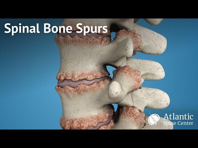 Spinal Bone Spurs