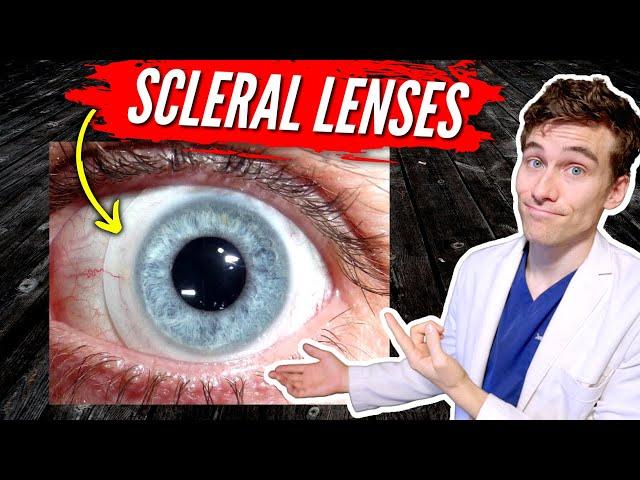 Scleral Lenses for Keratoconus: 7 Facts You Need to Know