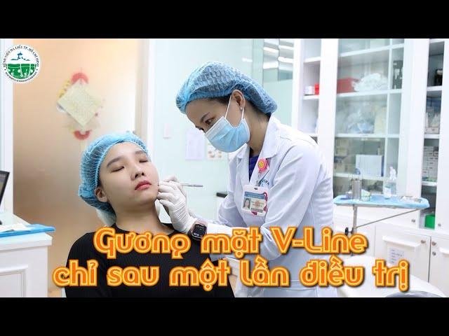 GƯƠNG MẶT V-LINE CHỈ SAU MỘT LẦN ĐIỀU TRỊ|| Bệnh viện Da Liễu TP.HCM