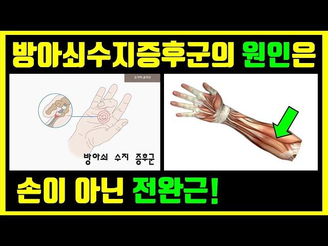 Fix your trigger finger/thumb with massage and special exercises/gliding. Visit mrphysio.net