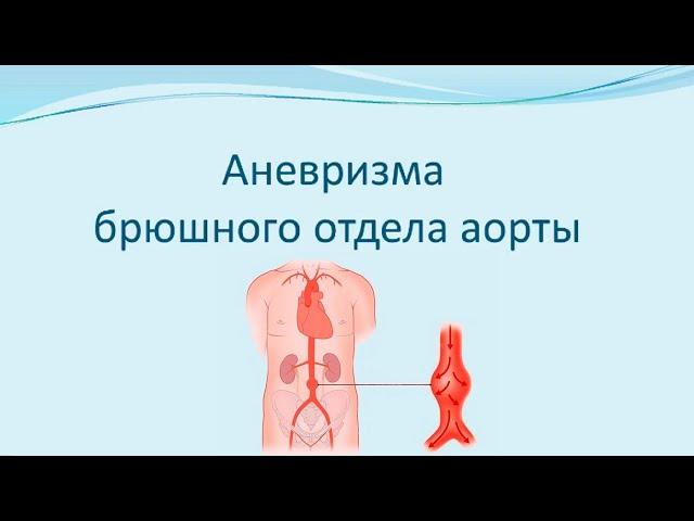 Аневризма брюшной аорты