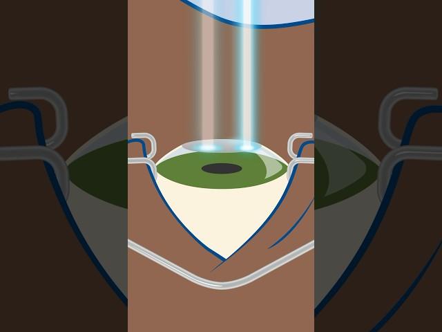 How does PRK surgery work to correct eyesight? #shorts