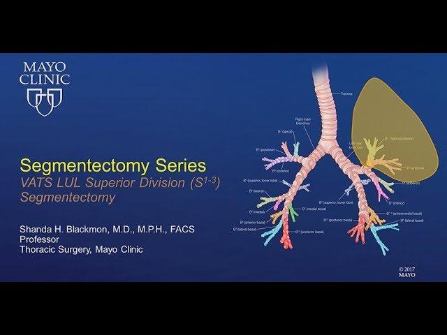 VATS Segmentectomy