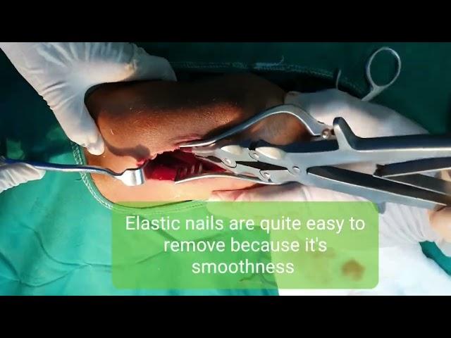 IM Elastic nailing removal | Adamya Hosp video