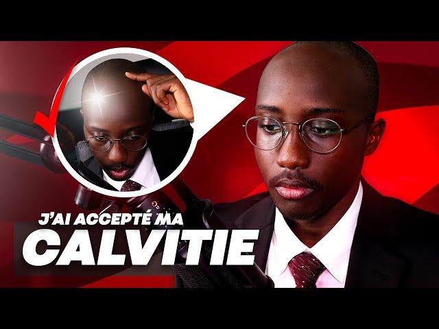 Comment j'ai accepté ma calvitie (perte de cheveux)