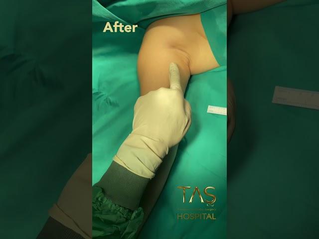 Transform Your Arms with Scarless Arm Lift by Dr. TAS | Expert Insights