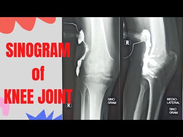 Technique  Sinogram of  knee joint (Ep-62) | knee joint sinography | sinogram procedure