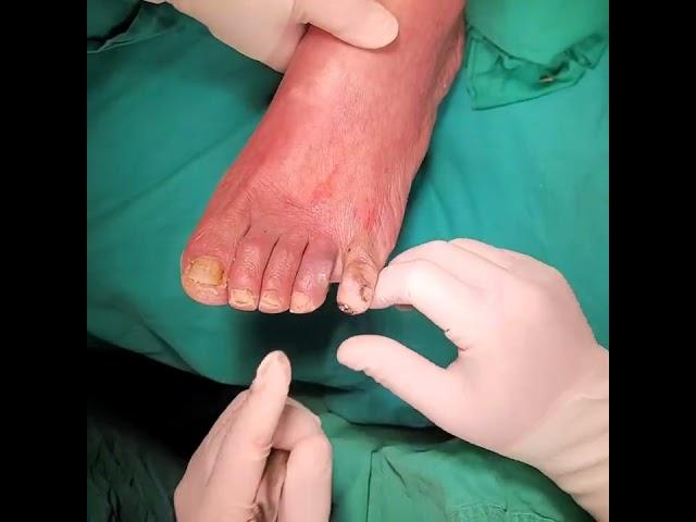 S2.Musical note bending (@-shape bending) of K-wire at Toe fixation (Case1. Kang's method)