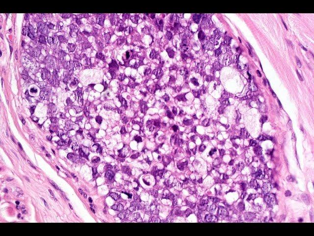 Sebaceous carcinoma McKee