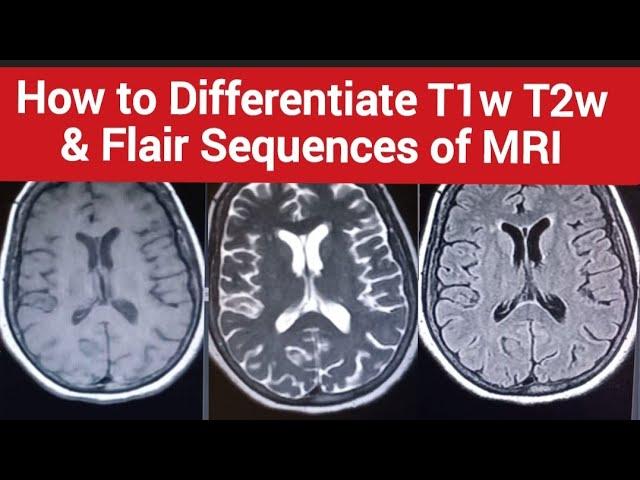 How to Differentiate T1w T2w and Flair Sequences of MRI | Easy to learn in just 2 mint