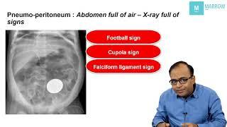 CONCEPTUAL RADIOLOGY ON MARROW - X ray signs in pneumo-peritoneum