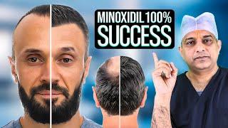 MINOXIDIL after Hair Transplant - Full Step-by-Step Guide for Hair Growth Tips | Saraswat Hospital