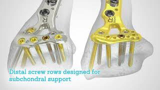 Acu-Loc® 2 Wrist Plating System with 2.7 mm Low Profile Hexalobe Screws Overview Animation