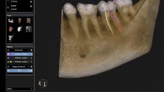 Carestream Dental 3D Imaging Root Canal Tracing