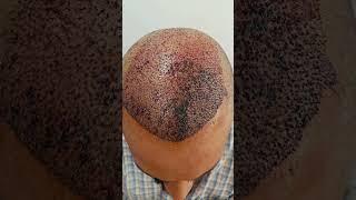 Hair Transplantation Before and After | Dr Rajeshwari's Health Care #shorts #viralshorts #hair