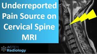 Cervical Spine Facet Pain on MRI