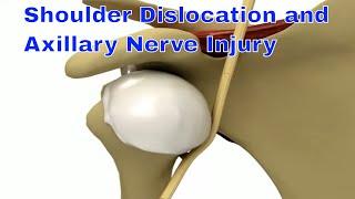 shoulder dislocation and axillary nerve injury 어깨 탈구와 연관된 액와신경 손상